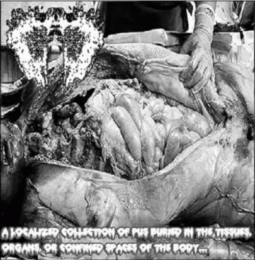 Carcinomas Of Unknown Primary Origin : A Localized Collection of Pus Buried in the Tissues, Organs, or Confined Spaces of the Body...